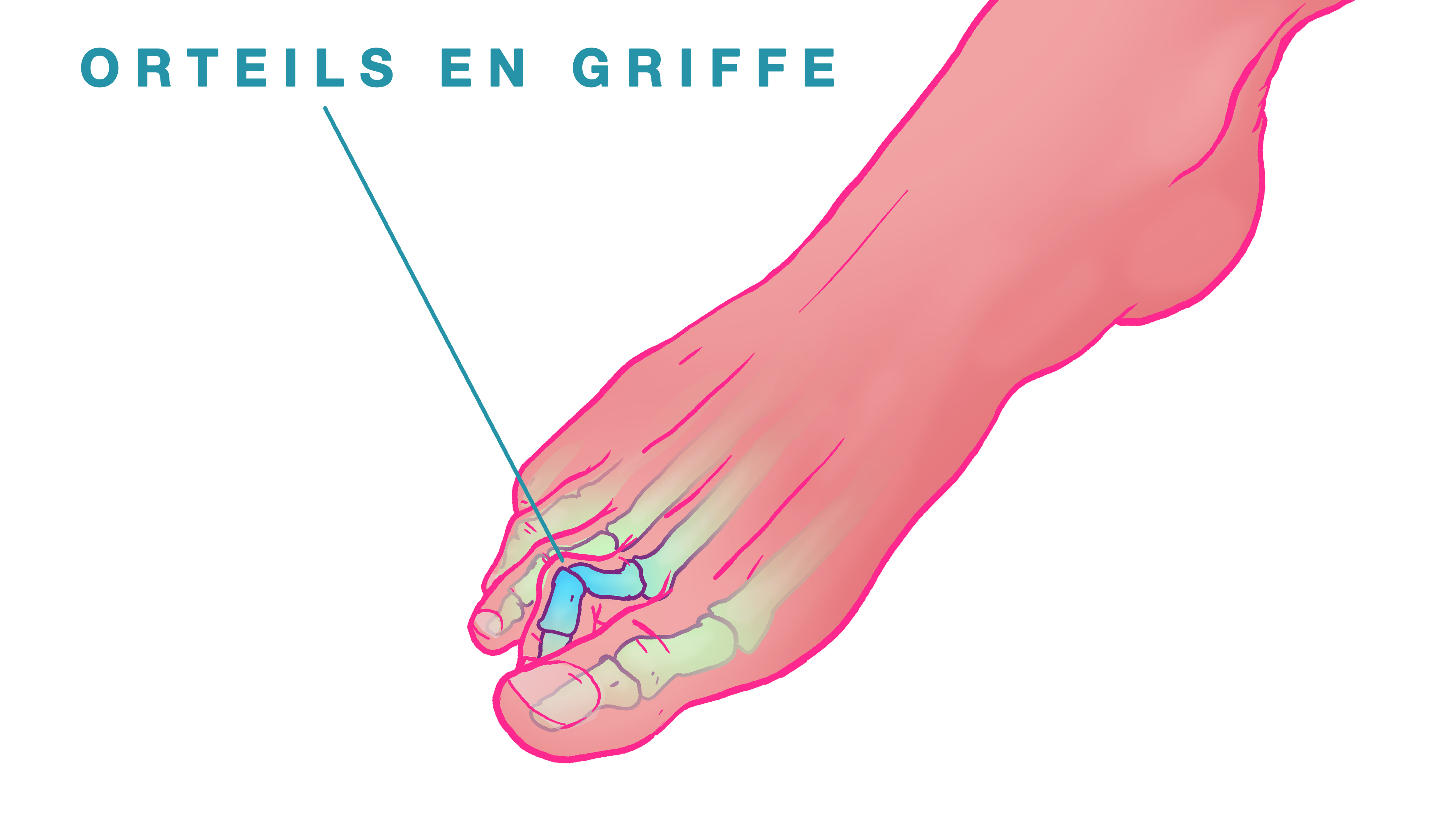 Orteils En Griffe Hallux Valgus Nice Chirurgie Pied Nice