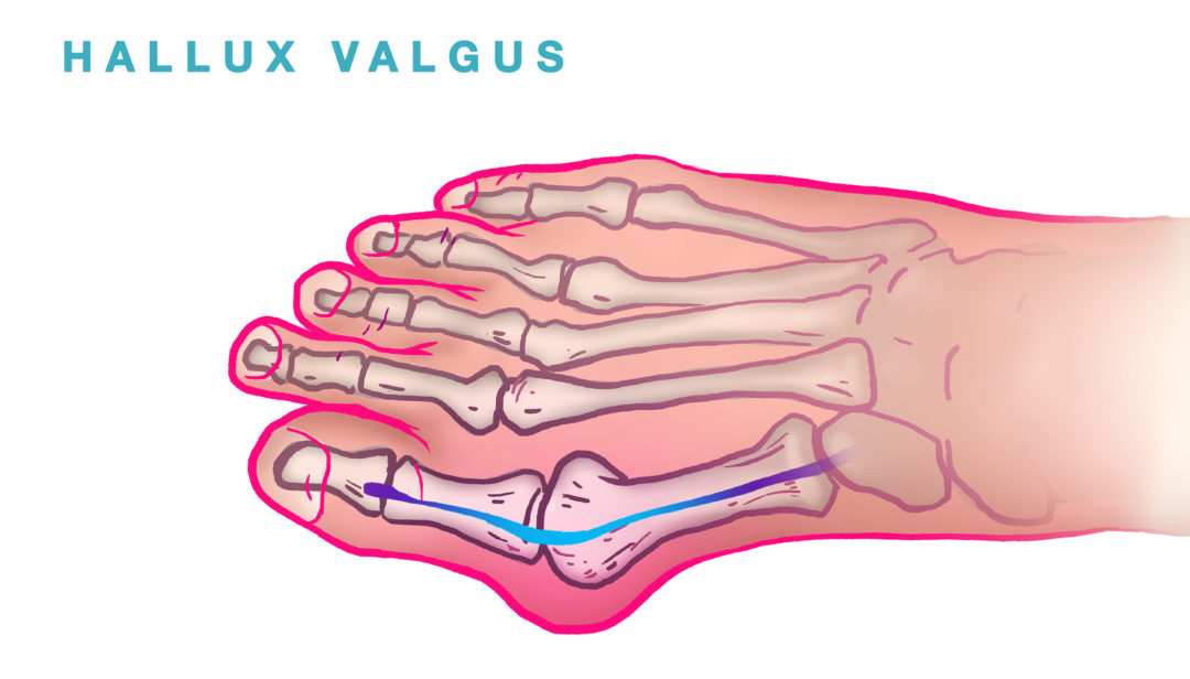Opération du pied 2021 Hallux Valgus Nice Chirurgie pied Nice — free download