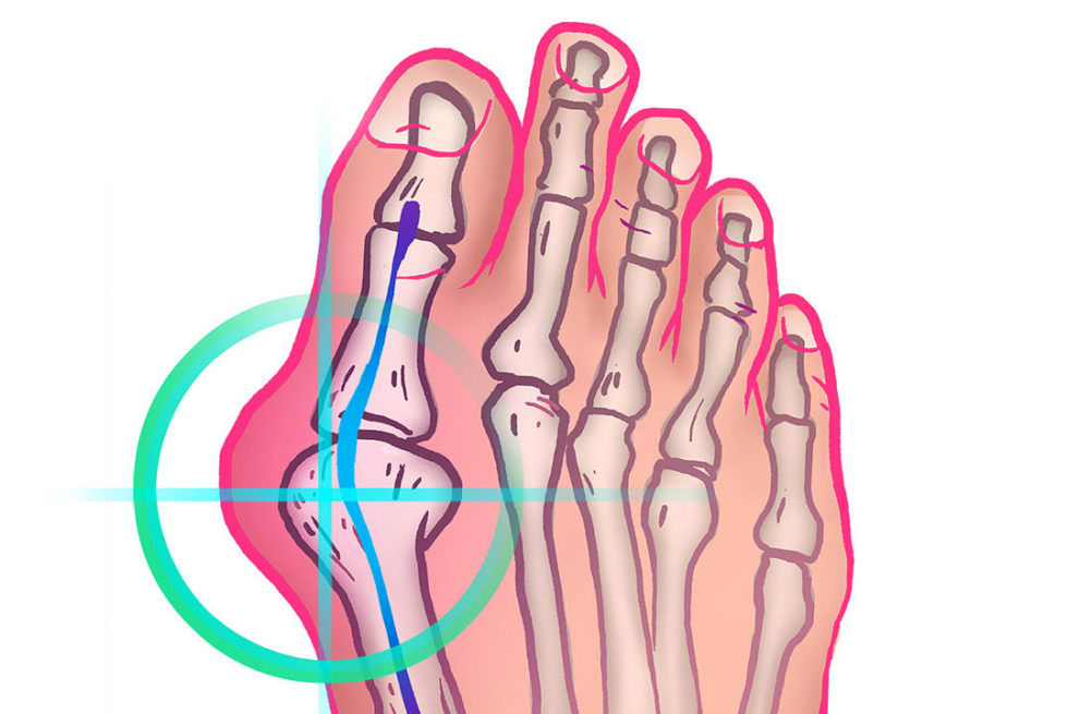 Opération du pied 2021 Hallux Valgus Nice Chirurgie pied Nice — free download